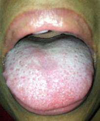 La lengua y que dice de tu salud